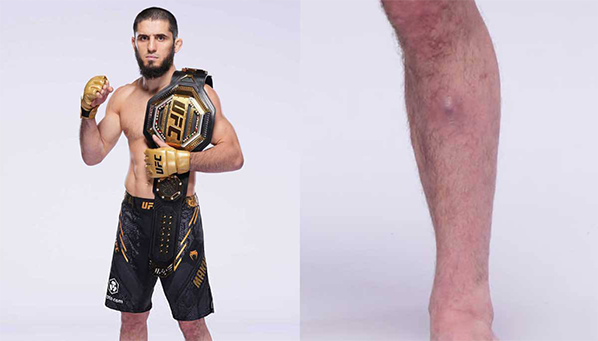 У Ислама Махачева обнаружили стафилококк?