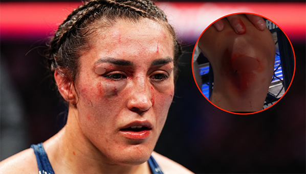 Колено Татьяны Суарес после боя с Вэйли